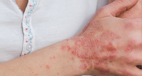 Doença autoimune de pele - divulgação