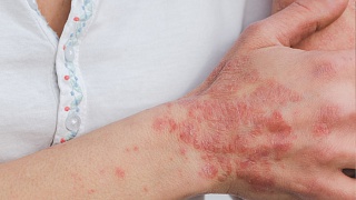 Doença autoimune de pele - divulgação