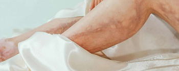 O que é vasculite cutânea e como ela pode atingir rins, pulmões e nervos - pexels