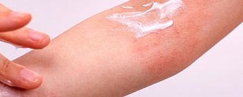  Dermatite atópica - divulgação