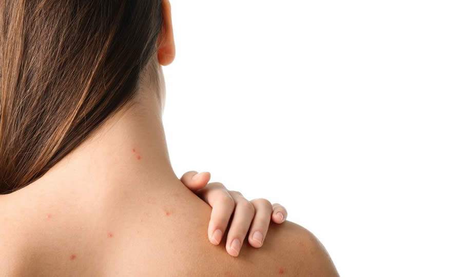 O que causa acne na região dos ombros/costas? Saiba como tratar
