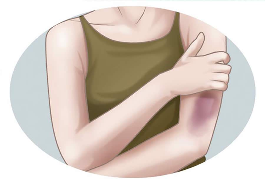 Hematoma que surge espontaneamente pode ser sinal de doenças