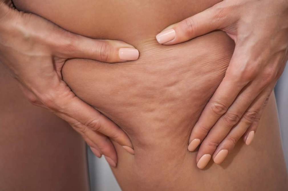 Celulite afeta cerca de 95% das mulheres