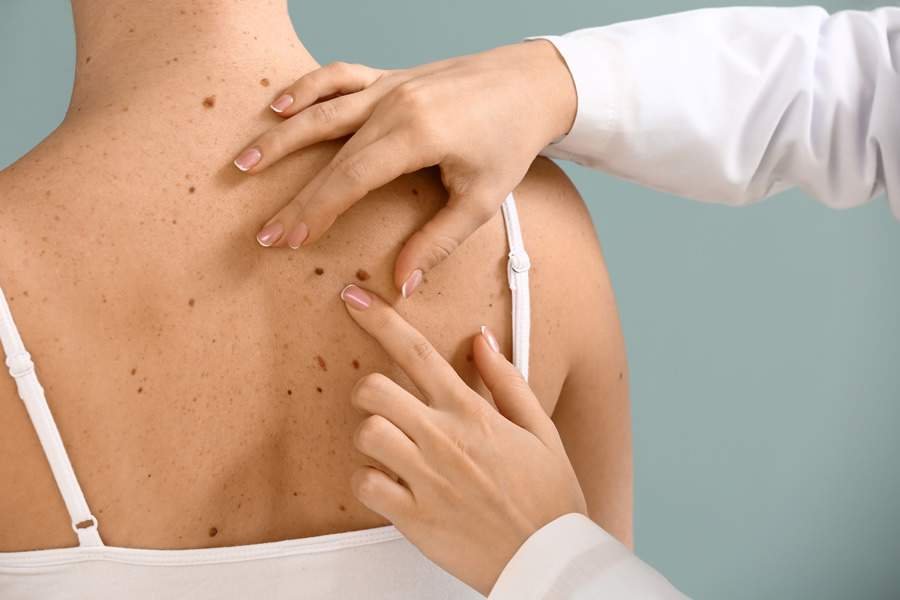 Câncer de pele: saiba como identificar os sinais e agir preventivamente