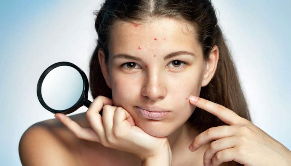 Insônia durante tratamento de acne com Roacutan é indício de efeito adverso psiquiátrico, diz estudo