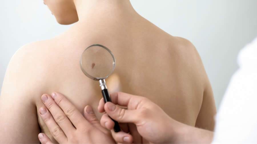 Diagn&oacute;stico precoce do c&acirc;ncer de pele contribui para um tratamento mais efetivo - Cr&eacute;dito: Canva