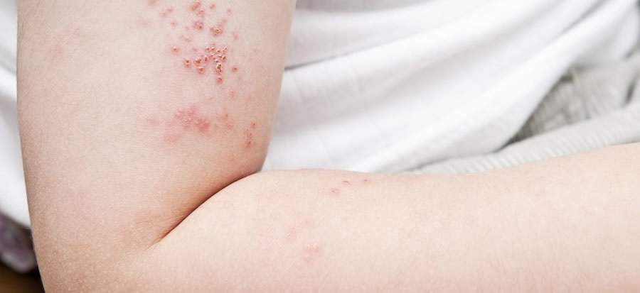 Nutrição contra o Herpes Zoster: Reforçando a Imunidade para Prevenção e Recuperação