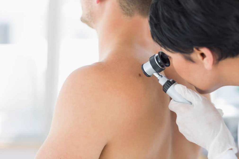 Segundo melanoma primário aumenta o risco de morte, diz estudo holandês