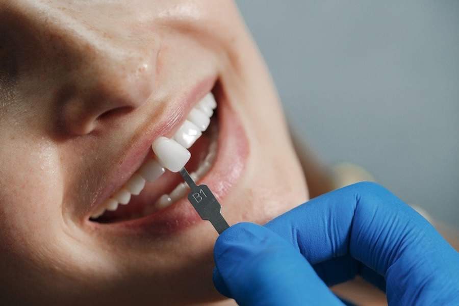 Entenda Por Que É Importante a Escolha Certa nas Facetas Dentárias
