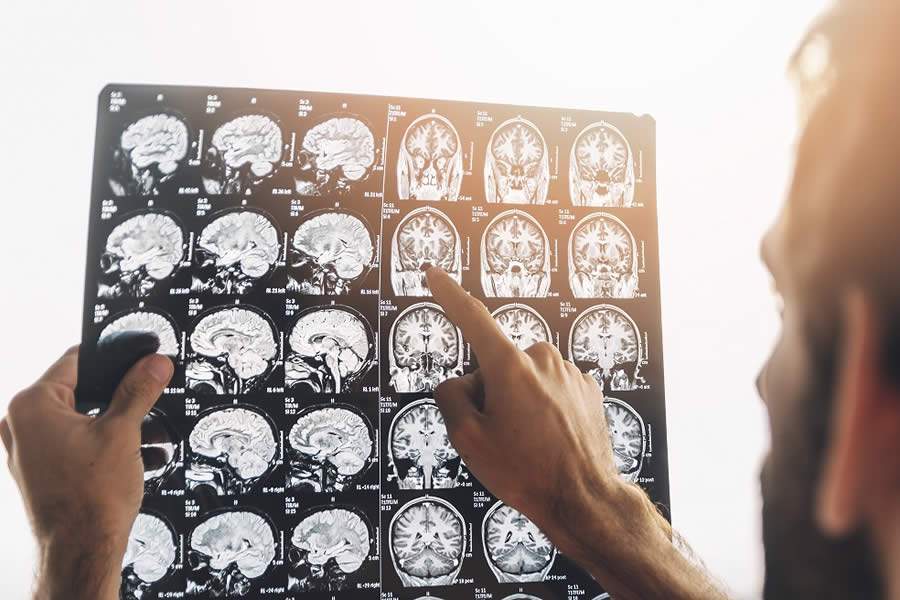 Maio cinza: tumores cerebrais têm maior índice de cura graças aos avanços da ciência
