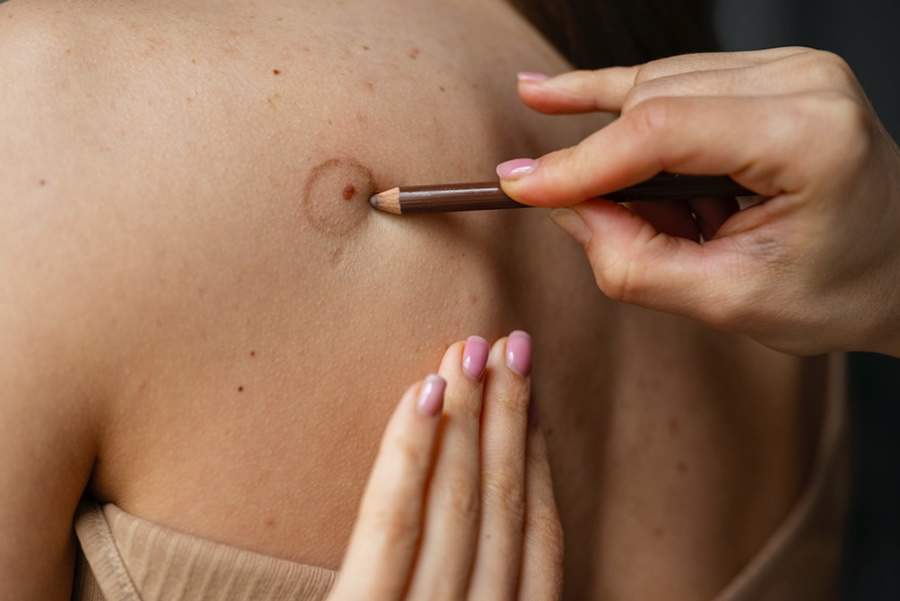 Você sabe como se proteger contra o melanoma?