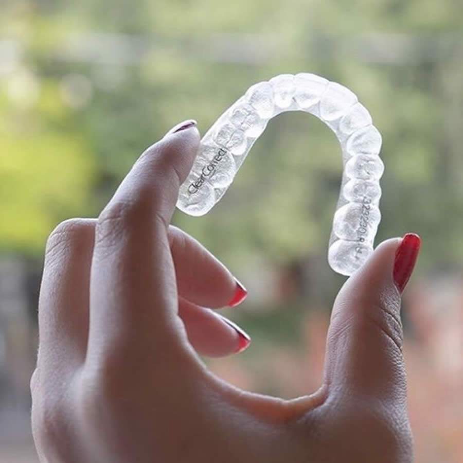  Al&eacute;m de ser discreto e eficiente, alinhador transparente tamb&eacute;m facilita a higieniza&ccedil;&atilde;o bucal e manuten&ccedil;&atilde;o pode ser feita a dist&acirc;ncia - Cr&eacute;dito: Grupo Straumann