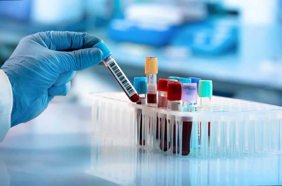 Resultado preliminar de estudo goiano aponta que não existe relação da tipagem sanguínea com casos graves da Covid-19 - Shutterstock