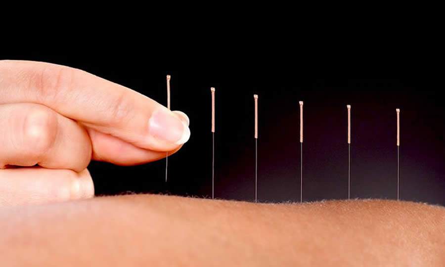 O acupunturista vai analisar o indiv&iacute;duo e aplicar um tratamento espec&iacute;fico nos pontos energ&eacute;ticos, nos quais ser&atilde;o aplicadas as finas agulhas - iStock