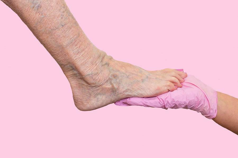 Varizes estouradas? E agora, o que fazer?