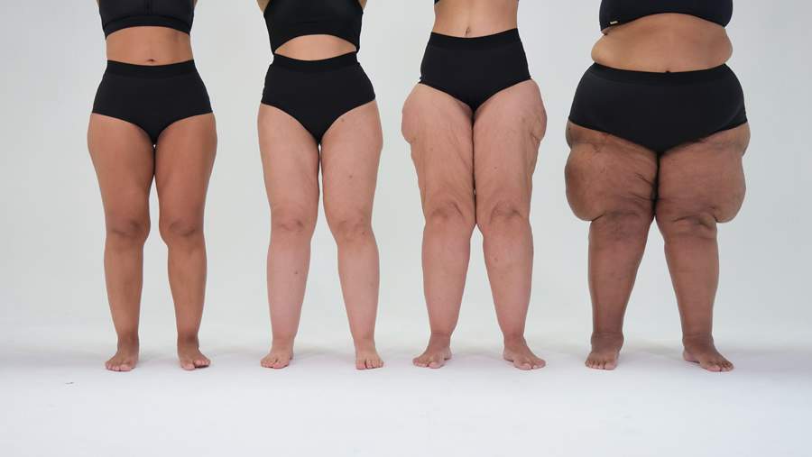 Diversos graus do lipedema. Foto:divulgação