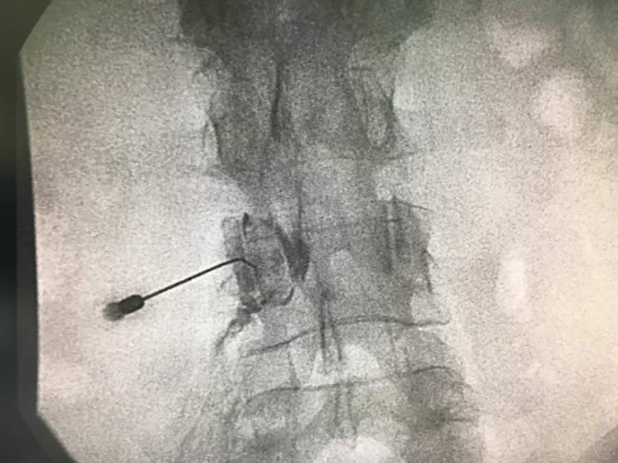 Dores cr&ocirc;nicas: medicina intervencionista prop&otilde;e tratamento minimamente invasivo