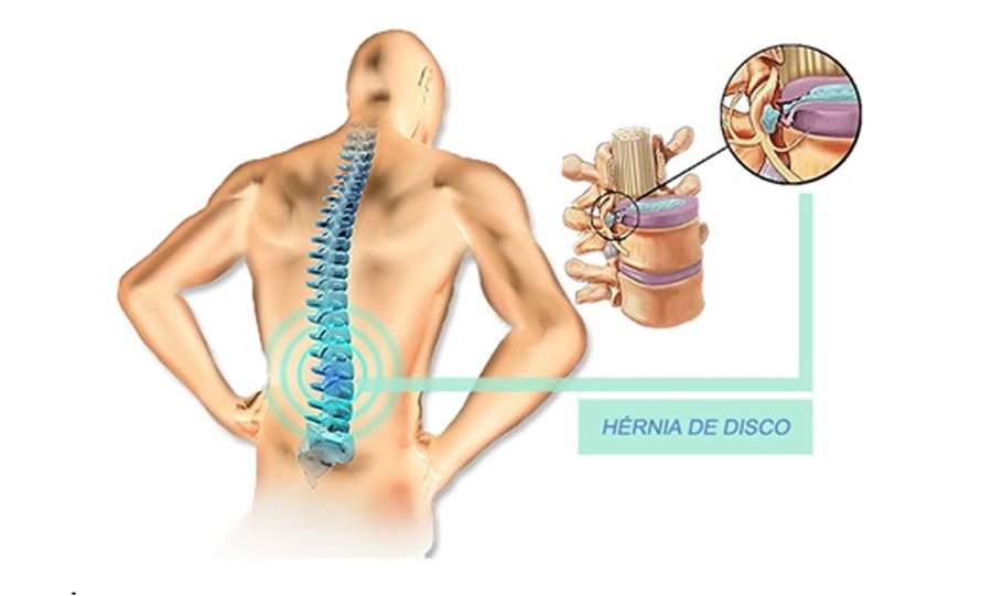 H&eacute;rnia de Disco: A Doen&ccedil;a Que Todo Mundo Acha Que Tem
