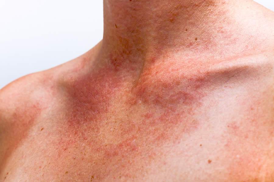 Envenenamento solar: reação à queimadura grave pode causar náuseas, febre e até desmaios