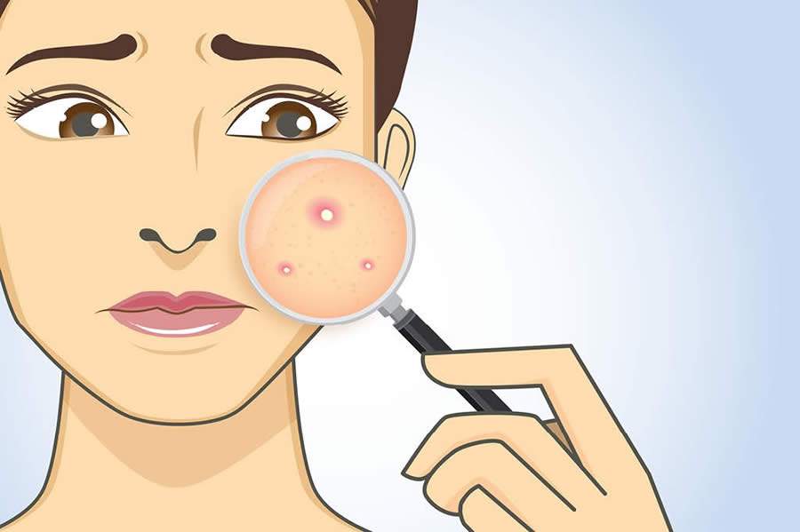 Ver&atilde;o pode causar mais oleosidade e acne na pele, cuidados devem ser mantidos