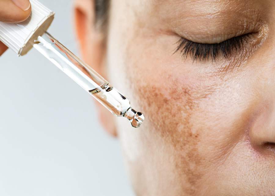 Melasma - Freepik