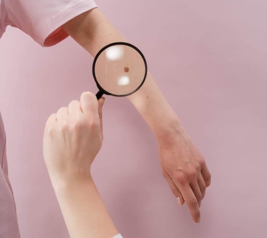 Exames moleculares podem ajudar no diagn&oacute;stico do c&acirc;ncer de pele