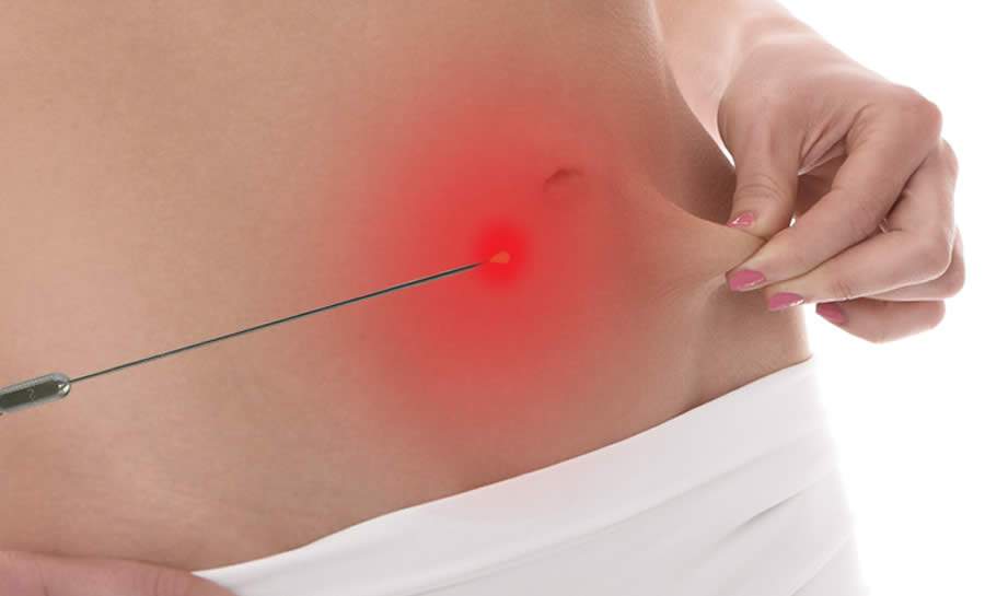 Menos invasiva, lipoaspiração a laser derrete gordura e retrai a pele, diminuindo a flacidez