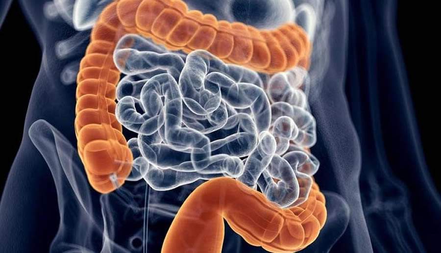 Doença Inflamatória Intestinal - A Importância do Diagnóstico Precoce Para Uma Vida Mais Saudável