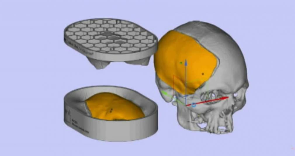 Fiocruz desenvolve tecnologia para reconstrução craniana