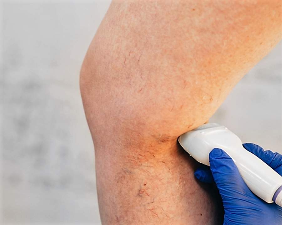 varizes- has - divulgação