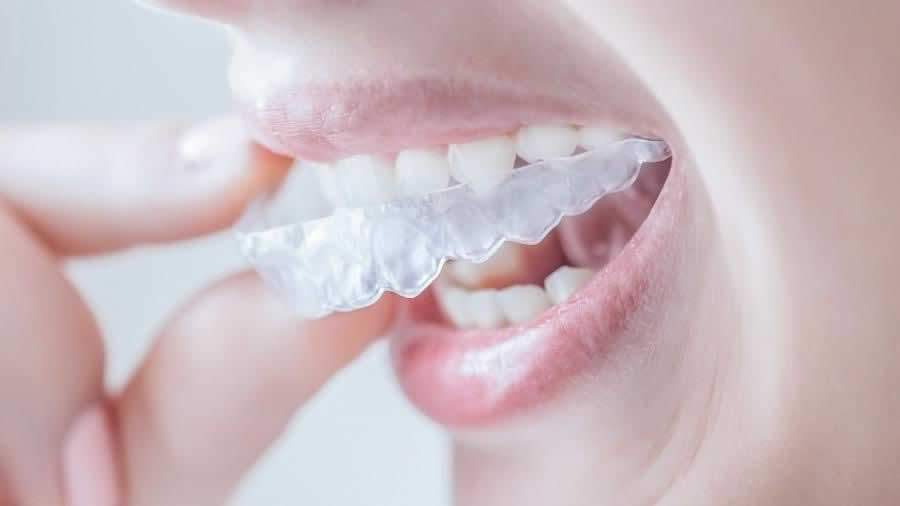 Aparelho invis&iacute;vel nacional x Invisalign: conhe&ccedil;a as principais diferen&ccedil;as