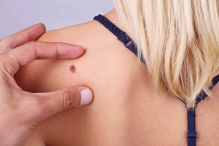 Risco de câncer de pele sobe 74% quando parentes de primeiro grau tiveram melanoma, diz estudo