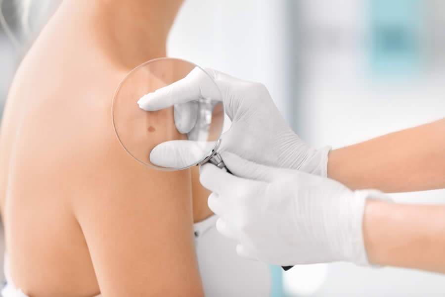 Junho Preto: aten&ccedil;&atilde;o &agrave; pele