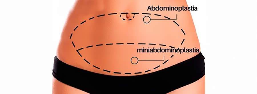 Miniabdominoplastia é eficiente em minimizar alterações inestéticas após a gravidez