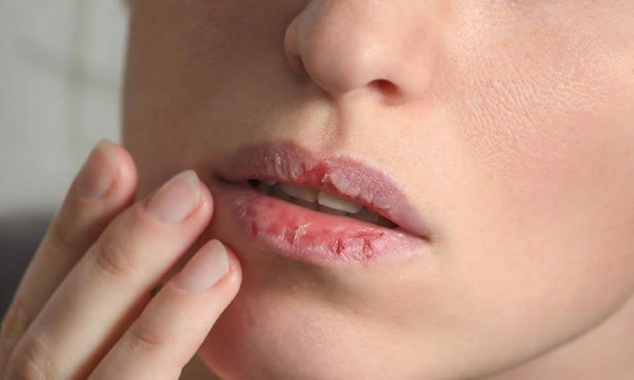 Estresse de quarentena: por que você precisa parar agora de morder ou lamber os lábios
