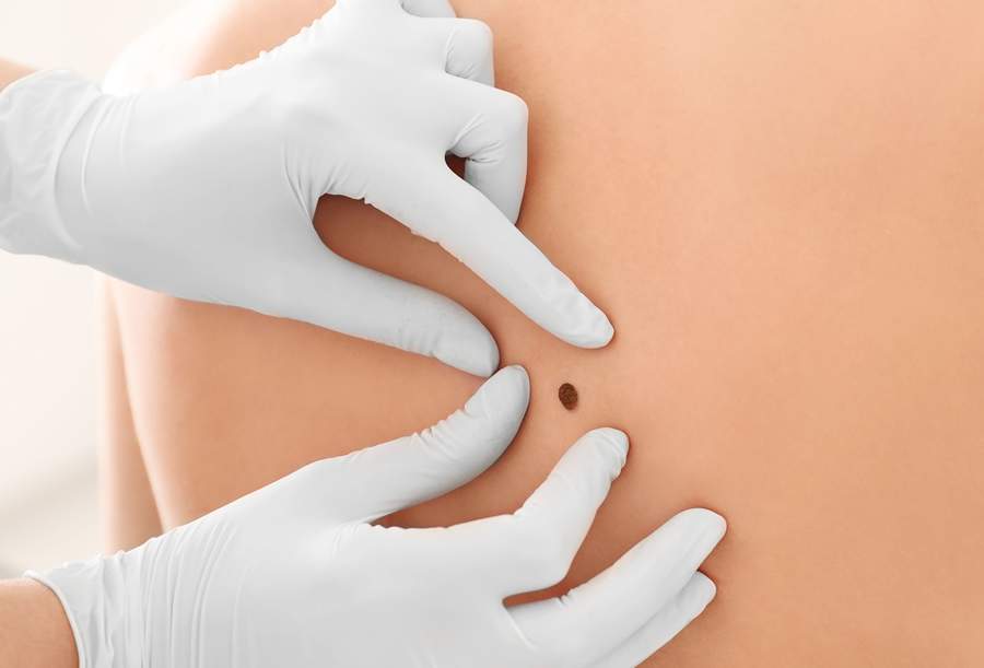 Câncer de pele - Adobe Stock Free