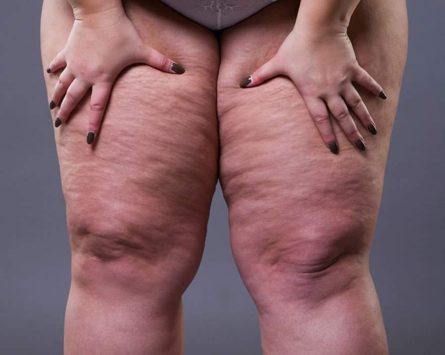 Lipedema: conheça doença confundida com obesidade que afeta mais de 11% das mulheres