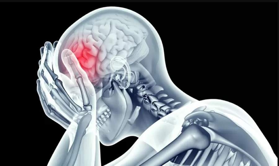 Dia Nacional de Combate &agrave; Cefaleia &eacute; em 19 de maio. Entenda mais sobre a doen&ccedil;a, seus tratamentos e preven&ccedil;&atilde;o - Getty Images