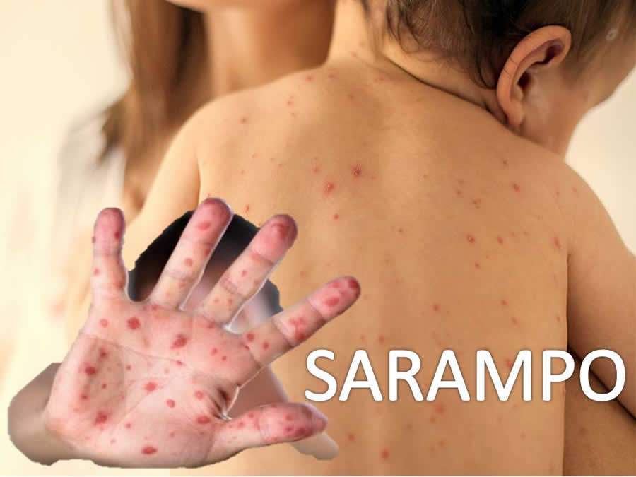 Especialista alerta para o perigo do retorno do sarampo