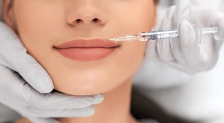 Preenchimento labial com ácido hialurônico - Divulgação