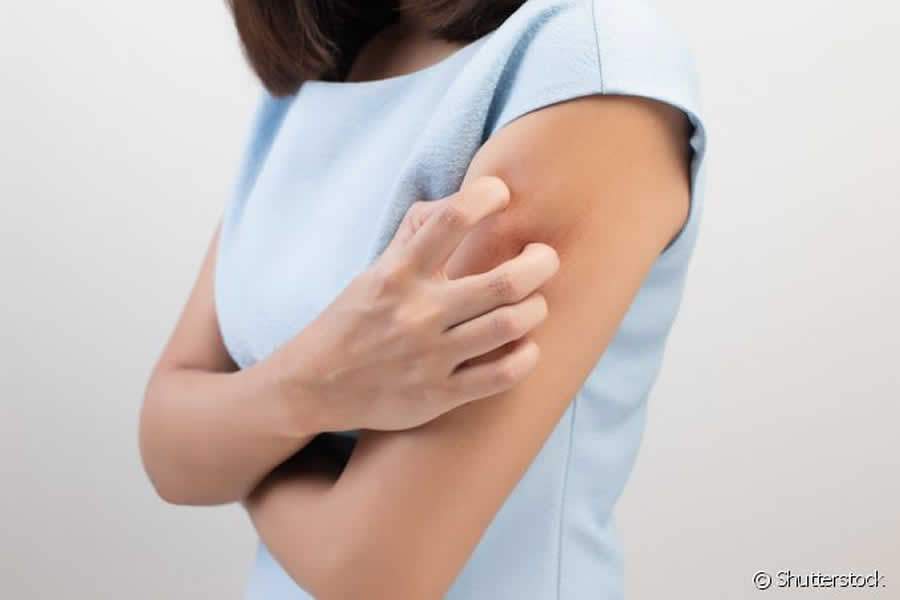 Impacto psicol&oacute;gico da psor&iacute;ase &eacute; t&atilde;o alto quanto o f&iacute;sico e tratamento deve incluir sa&uacute;de mental