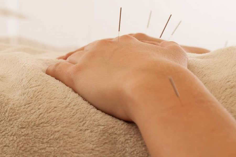 Conheça 3 (ótimos) motivos para se render a milenar técnica chinesa: a acupuntura