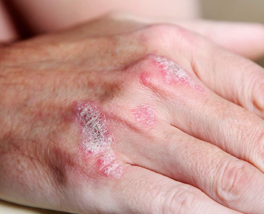 Redes sociais aliadas à causa da doença psoríase