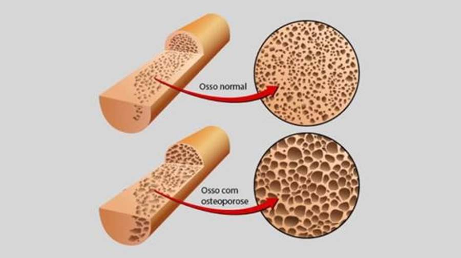 J&aacute; ouviu falar em doen&ccedil;as osteomusculares?