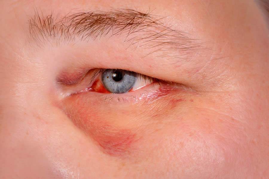 Você sabe o que é lesão ocular?