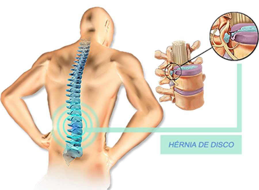 Hérnia De Disco: A Doença Que Todo Mundo Acha Que Tem