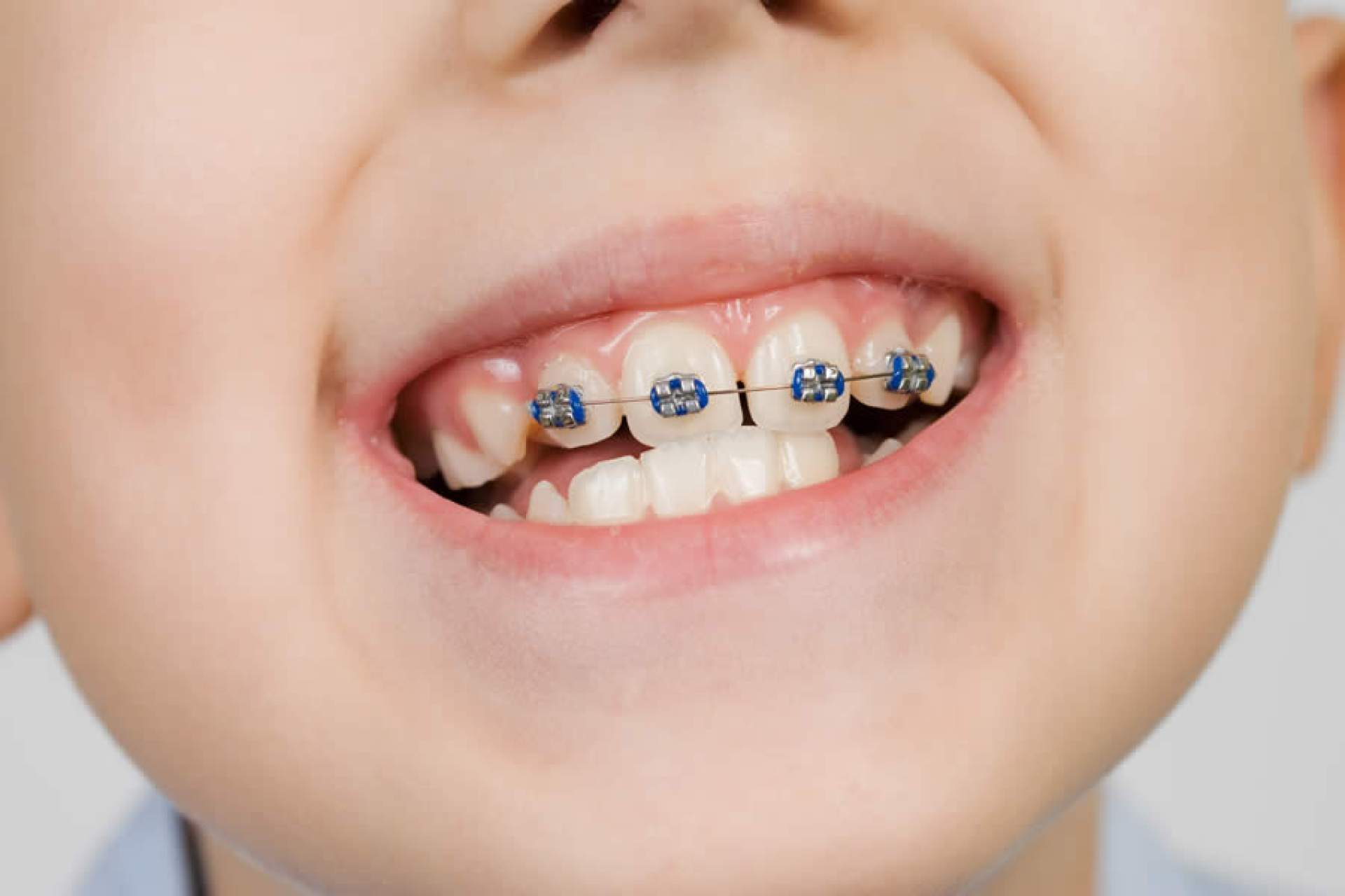 Брекеты на зубы для детей сколько стоят. Частичная брекет-система 2x4. Частичная брекет система 2 на 4.