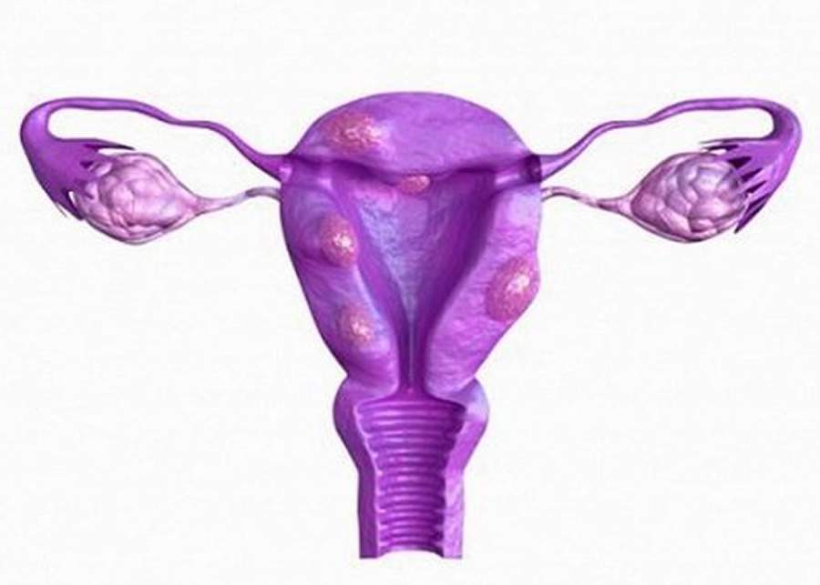 Conhe&ccedil;am 4 tipos de cisto ovarianos