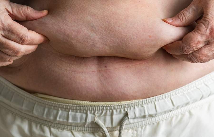 Pesquisa indica que risco de câncer de mama em mulheres obesas é 42% maior em comparação com pacientes que realizaram cirurgia bariátrica - Créditos: Envato