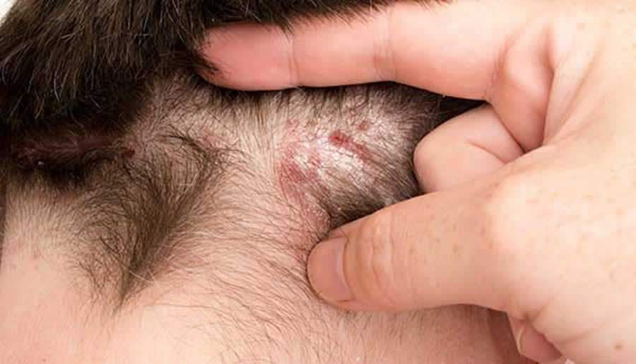 Dezembro Laranja alerta: Câncer de Pele também pode ocorrer no Couro Cabeludo